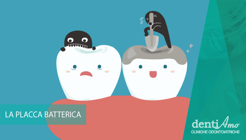 Cosa è la placca batterica e come combatterla