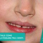 diastema-dentale-come-correggere-la-fessura-tra-i-denti